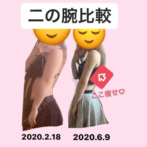 脂肪吸引（二の腕） ヨンセスリムライン AFTER メイン用