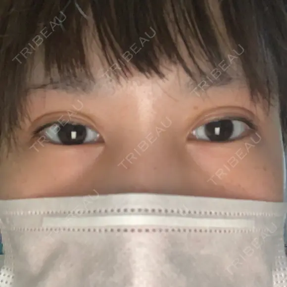 二重埋没 湘南美容クリニック 赤坂見附院 DAY 2 メイン用