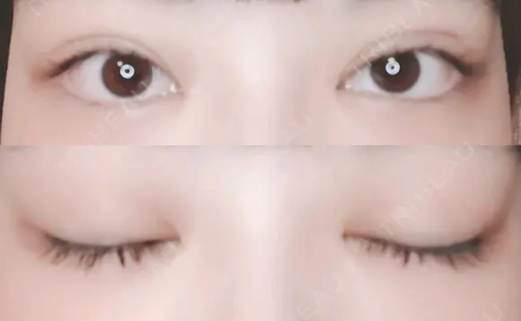二重切開 / 目頭切開 / 上まぶたたるみ取り 湘南美容クリニック 金沢院 DAY 95 メイン用