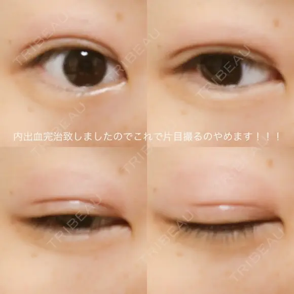 二重埋没 湘南美容クリニック 大阪堺東院 DAY 21 メイン用