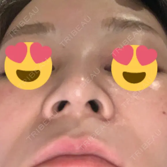 スレッドノーズ 品川スキンクリニック銀座院 DAY 6 メイン用