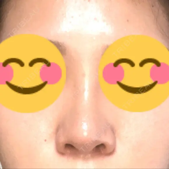 隆鼻術 たにまちクリニック AFTER メイン用
