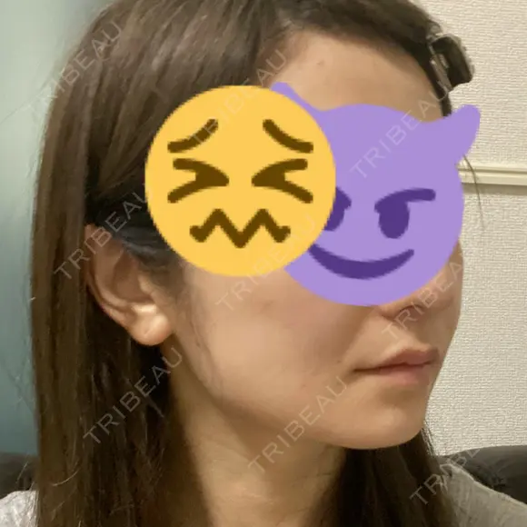 骨削り（頬） RG整形外科（旧リオン整形外科） AFTER メイン用