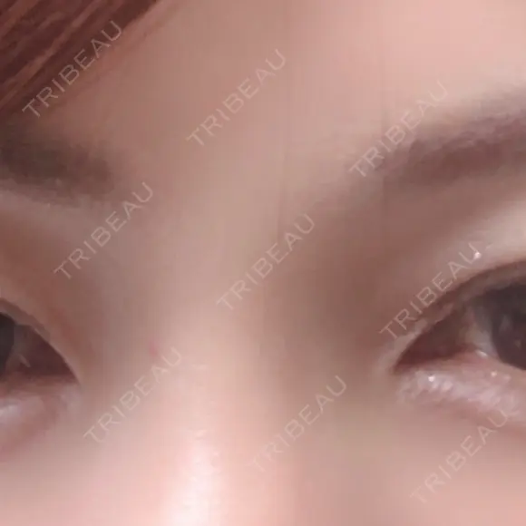 クマ治療 / ヒアルロン酸注入（涙袋） プラストクリニック AFTER メイン用