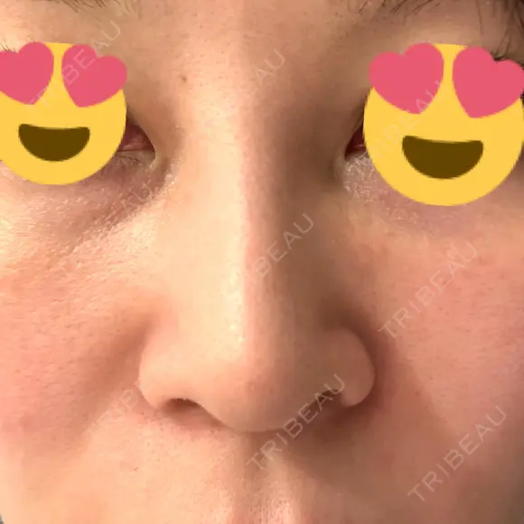 スレッドノーズ 品川スキンクリニック銀座院 DAY 7 メイン用