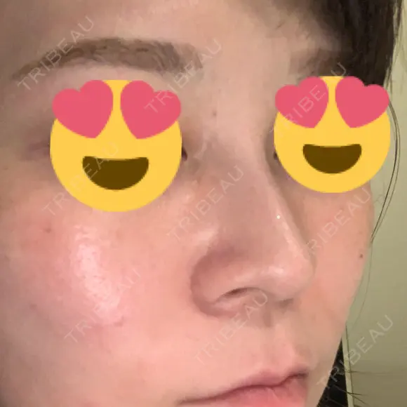 スレッドノーズ 品川スキンクリニック銀座院 DAY 7 メイン用