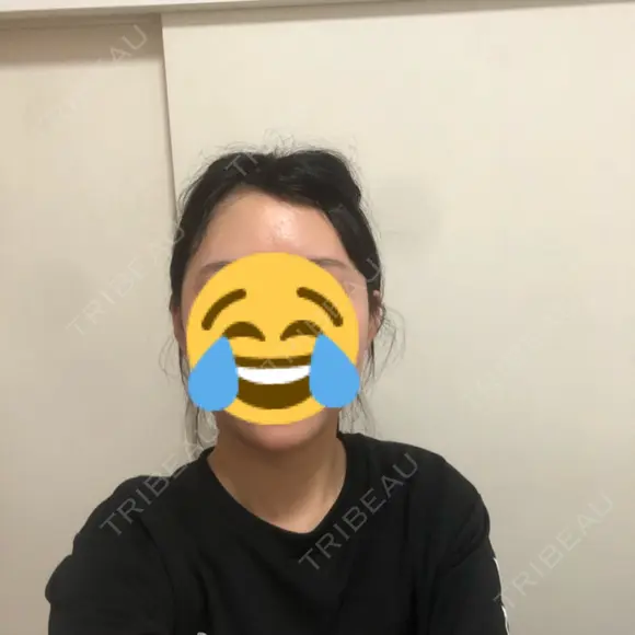 骨切り（あご） / 骨削り（エラ） ボンディ美容整形外科（旧リオン整形外科） AFTER メイン用