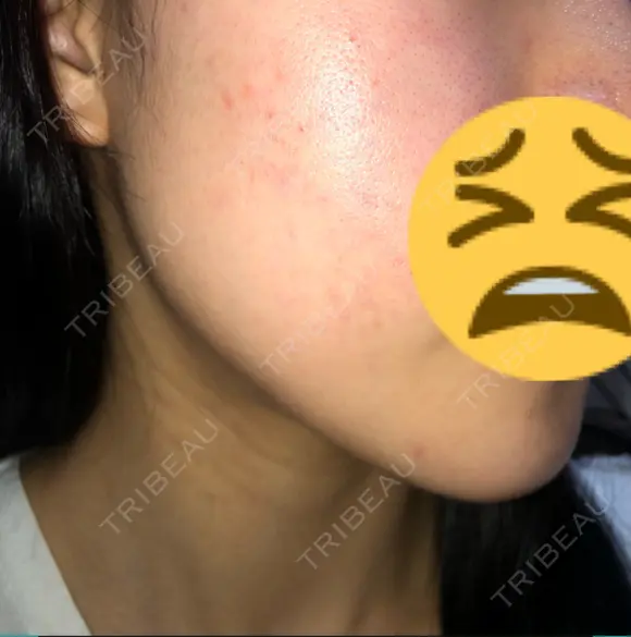 骨切り（あご） / 骨削り（エラ） ボンディ美容整形外科（旧リオン整形外科） DAY 108 メイン用