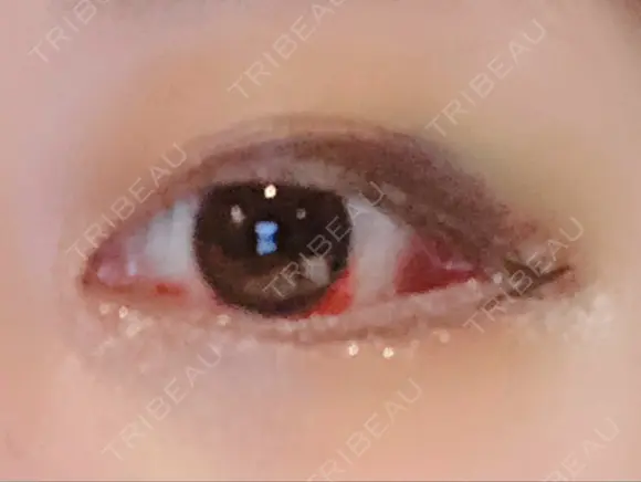 目頭切開 / 目尻切開 FROM B整形外科 (旧バウム整形外科) DAY 6 メイン用