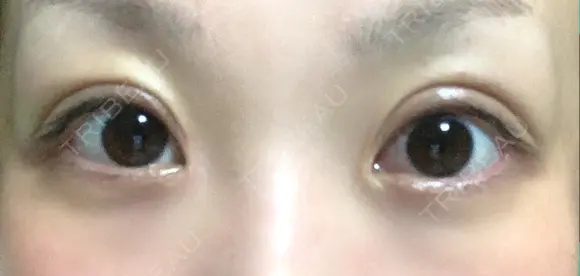 二重切開 / 目頭切開 ばん皮膚科 AFTER メイン用