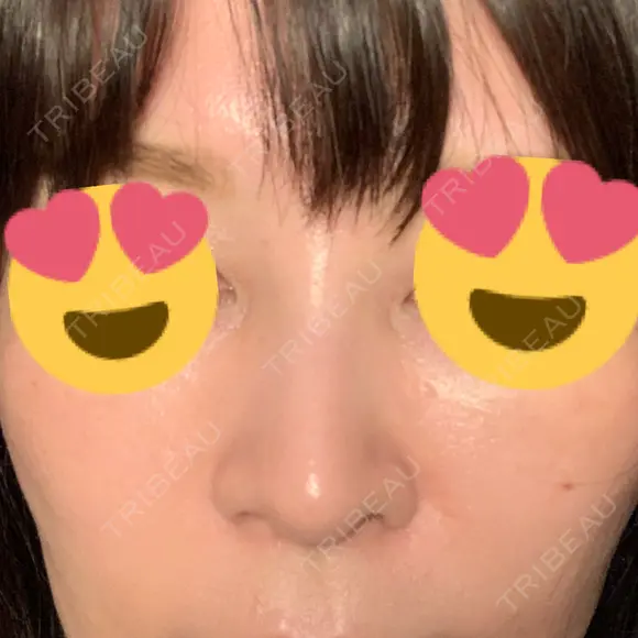 スレッドノーズ 品川スキンクリニック銀座院 AFTER メイン用