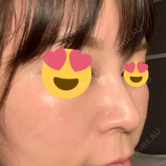 スレッドノーズ 品川スキンクリニック銀座院 DAY 10 メイン用