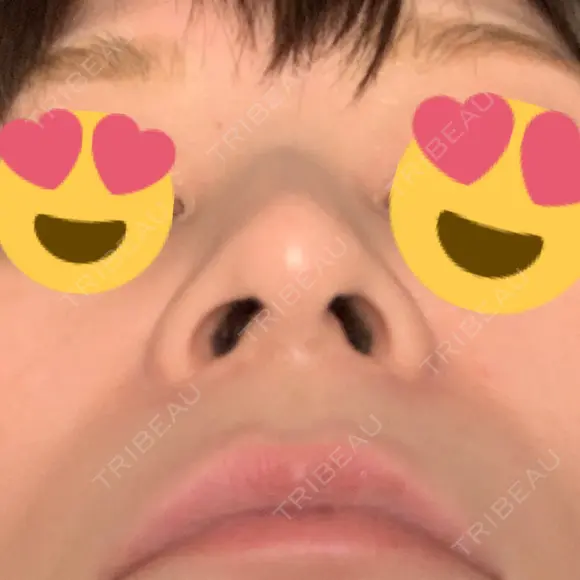 スレッドノーズ 品川スキンクリニック銀座院 DAY 10 メイン用