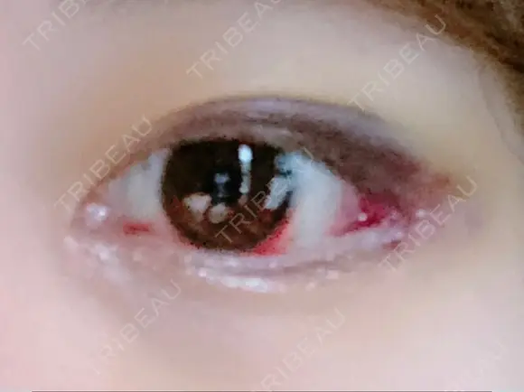 目頭切開 / 目尻切開 FROM B整形外科 (旧バウム整形外科) DAY 7 メイン用