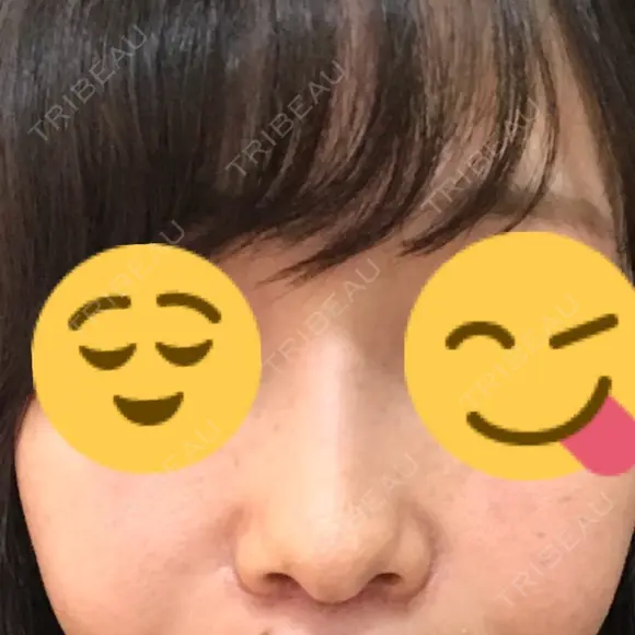 小鼻縮小（切開） / その他（鼻） 湘南メディカル記念病院（両国） DAY 14 メイン用