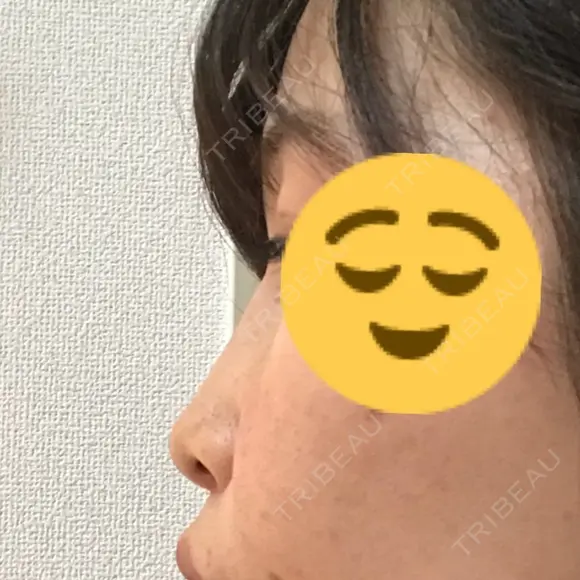 小鼻縮小（切開） / その他（鼻） 湘南メディカル記念病院（両国） DAY 14 メイン用