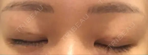二重埋没 湘南美容クリニック 宇都宮院 DAY 16 メイン用