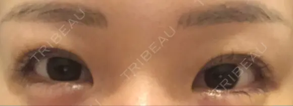 二重埋没 湘南美容クリニック 宇都宮院 DAY 16 メイン用