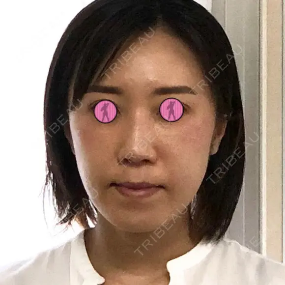 肌ヒアルロン酸注入（たるみ・シワ改善） / ヒアルロン酸注入（頬） 青山外苑前クリニック DAY 15 メイン用