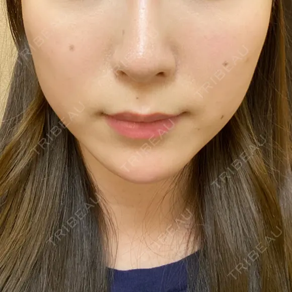 ハイフ（顔） Zetith Beauty Clinic 銀座院 DAY 22 メイン用