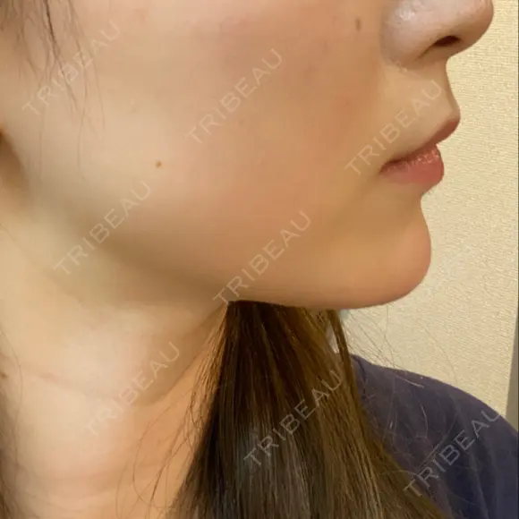 ハイフ（顔） Zetith Beauty Clinic 銀座院 DAY 22 メイン用