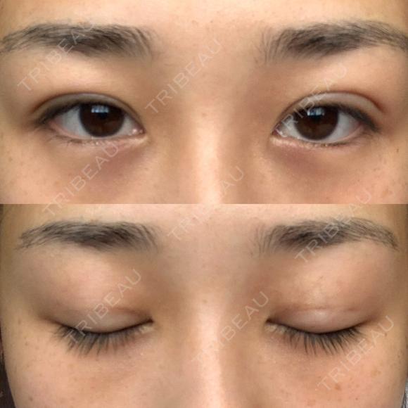 二重埋没 湘南美容クリニック 西宮北口院 DAY 18 メイン用