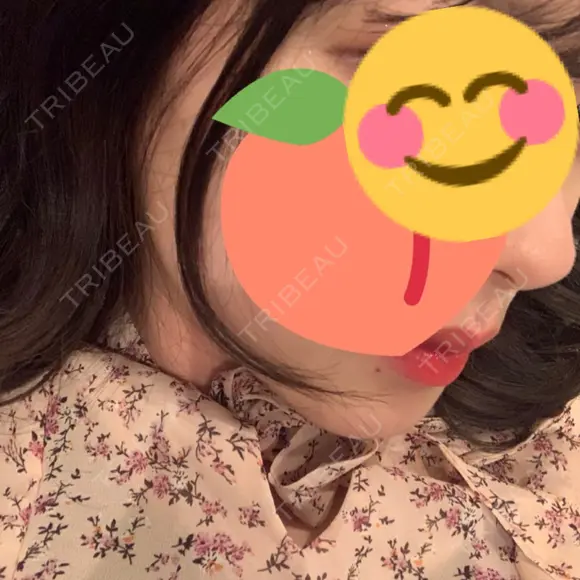 骨切り（あご） / 骨削り（エラ） ボンディ美容整形外科（旧リオン整形外科） DAY 91 メイン用