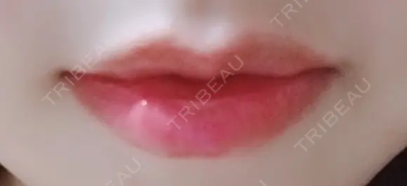 口唇縮小術 B-LINE CLINIC 池袋院 AFTER メイン用