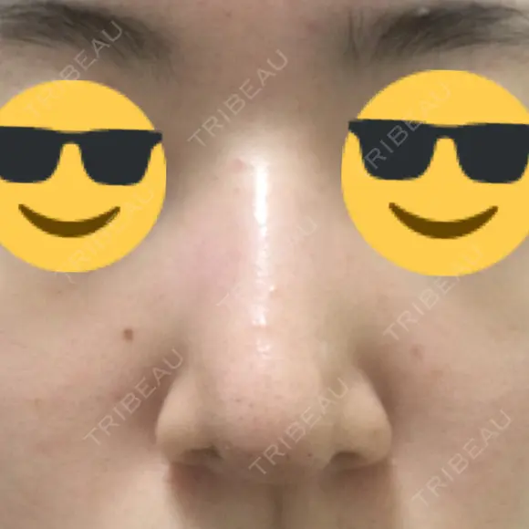 鼻尖縮小 / ヒアルロン酸注入（鼻） 東京ヒルズクリニック 新宿院 DAY 8 メイン用