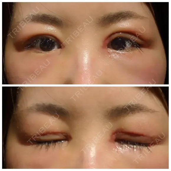 二重切開 / 目頭切開 / 眼瞼下垂（切開） / 目尻切開 湘南美容クリニック 大阪堺東院 DAY 7 メイン用