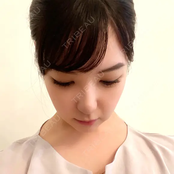 骨削り（頬） / 脂肪吸引（顔） / ボトックス（エラ・小顔） / ボトックス（ふくらはぎ） / ヒアルロン酸注入（額） / ボトックス（肩） RG整形外科（旧リオン整形外科） AFTER メイン用