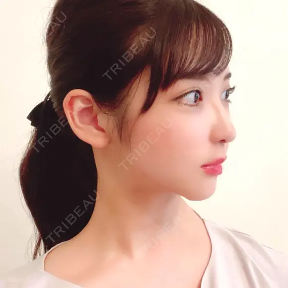 骨削り（頬） / 脂肪吸引（顔） / ボトックス（エラ・小顔） / ボトックス（ふくらはぎ） / ヒアルロン酸注入（額） / ボトックス（肩） RG整形外科（旧リオン整形外科） DAY 139 メイン用