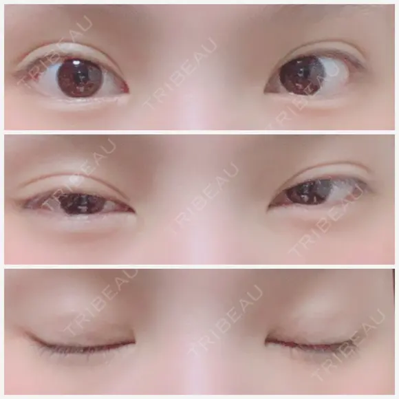 二重埋没 ビスポーククリニック 福岡院 AFTER メイン用