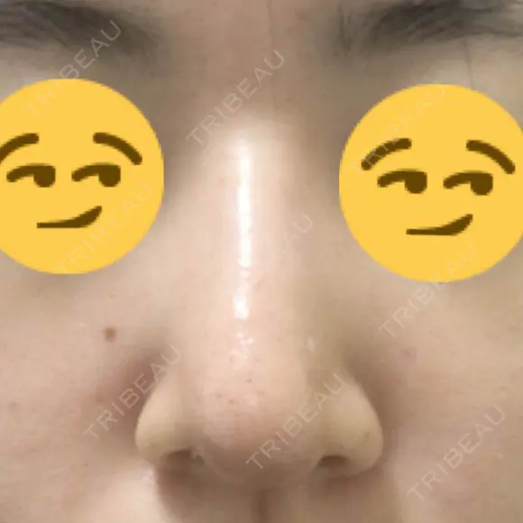 鼻尖縮小 / ヒアルロン酸注入（鼻） 東京ヒルズクリニック 新宿院 DAY 9 メイン用