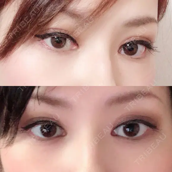 二重埋没 / 目頭切開 / 上まぶたの脂肪取り 十仁美容整形 AFTER メイン用