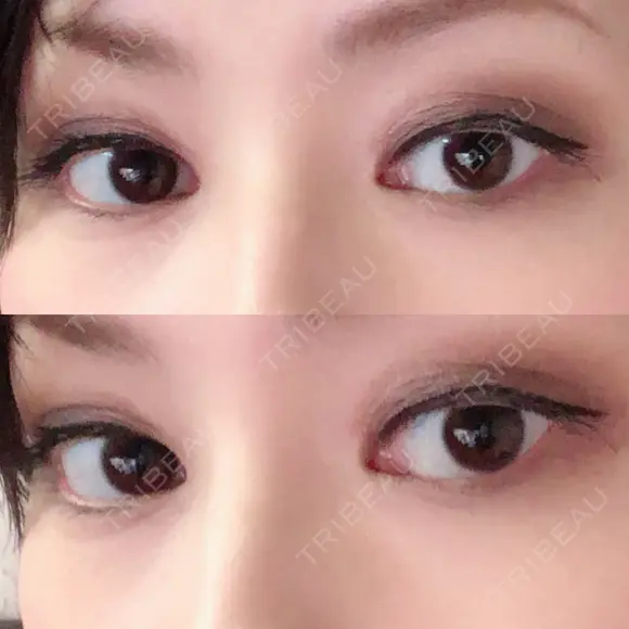 二重埋没 / 目頭切開 / 上まぶたの脂肪取り 十仁美容整形 DAY 190 メイン用