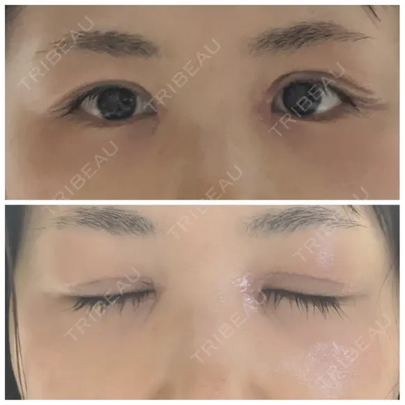 二重切開 / 目頭切開 / 眼瞼下垂（切開） / 目尻切開 湘南美容クリニック 大阪堺東院 DAY 8 メイン用