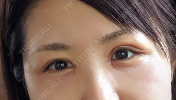 二重切開 / 目頭切開 / 眼瞼下垂（切開） / 目尻切開 湘南美容クリニック 大阪堺東院 DAY 8 メイン用