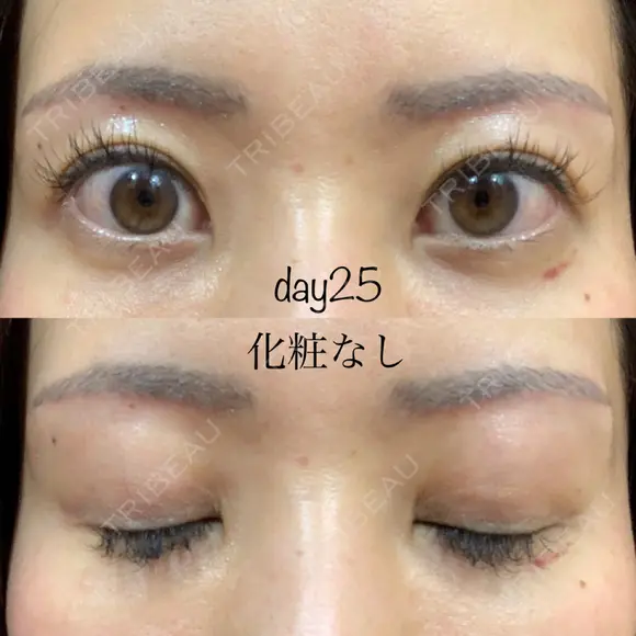 眉下切開 湘南美容クリニック 秋葉原院 DAY 25 メイン用