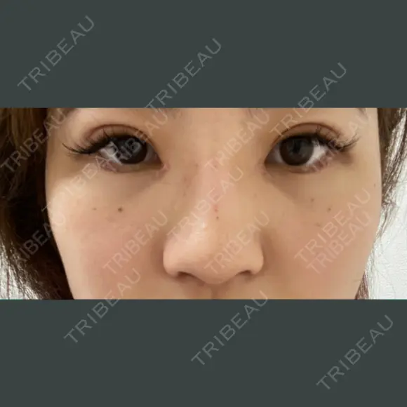 ヒアルロン酸注入（鼻） 銀座TAクリニック DAY 0 メイン用