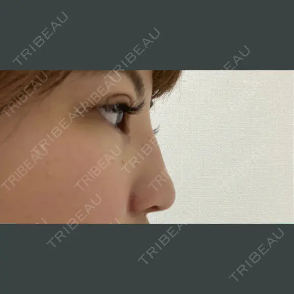 ヒアルロン酸注入（鼻） 銀座TAクリニック DAY 0 メイン用