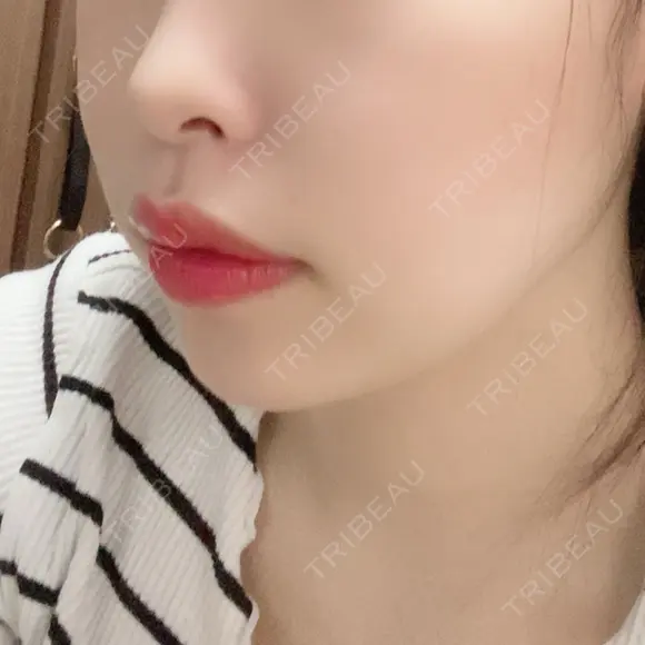 脂肪溶解注射（顔） 赤坂プレミアクリニック DAY 3 メイン用