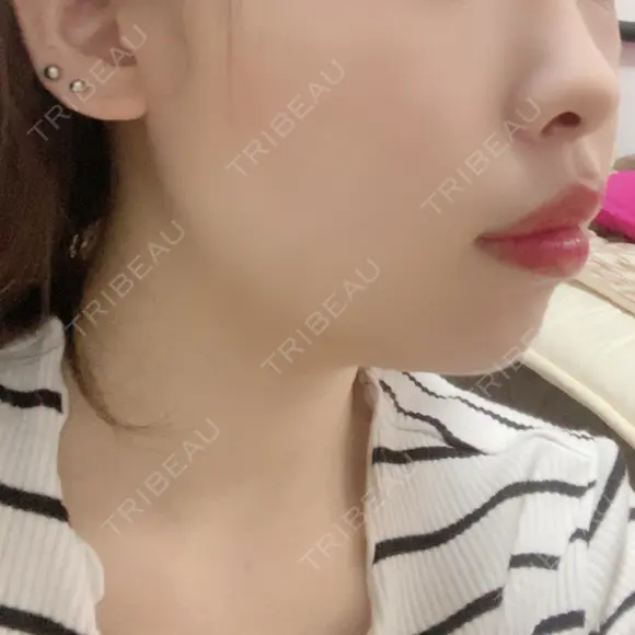 脂肪溶解注射（顔） 赤坂プレミアクリニック DAY 3 メイン用