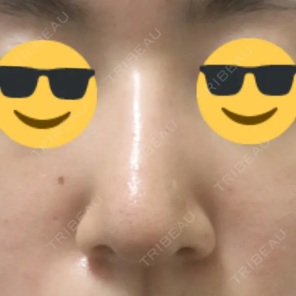 鼻尖縮小 / ヒアルロン酸注入（鼻） 東京ヒルズクリニック 新宿院 DAY 11 メイン用