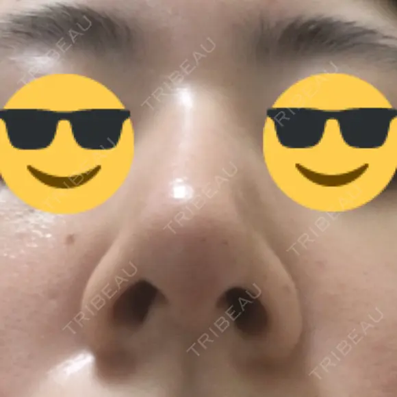 鼻尖縮小 / ヒアルロン酸注入（鼻） 東京ヒルズクリニック 新宿院 DAY 11 メイン用