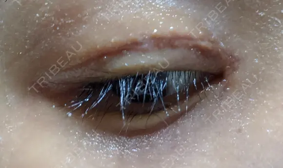 二重切開 / 目頭切開 / 眼瞼下垂（切開） / 目尻切開 湘南美容クリニック 大阪堺東院 DAY 10 メイン用