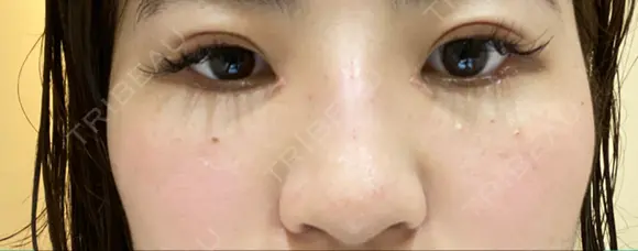 ヒアルロン酸注入（鼻） 銀座TAクリニック DAY 1 メイン用