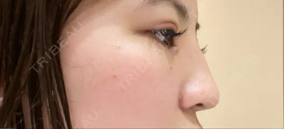 ヒアルロン酸注入（鼻） 銀座TAクリニック DAY 1 メイン用