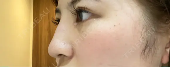 ヒアルロン酸注入（鼻） 銀座TAクリニック DAY 1 メイン用