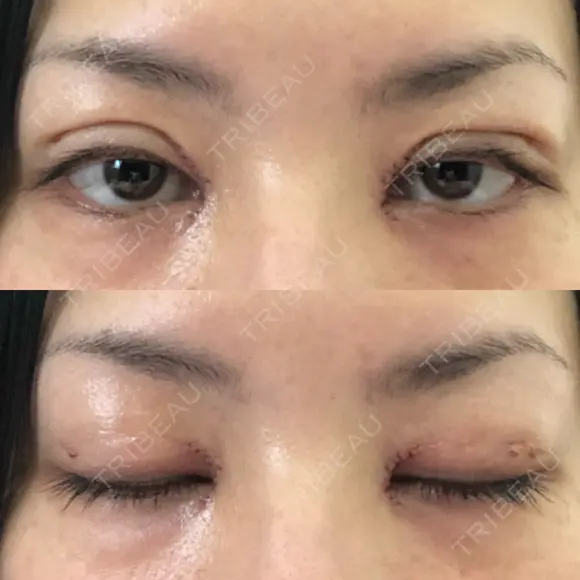 二重埋没 / 目頭切開 / 上まぶたの脂肪取り 十仁美容整形 DAY 0 メイン用